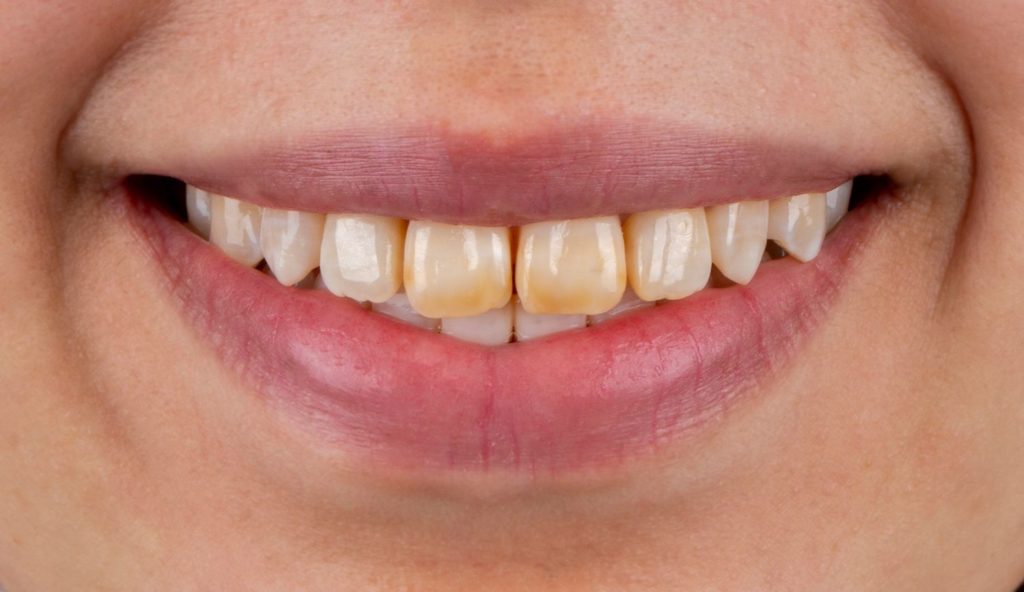 Vorher: Lächeln mit unebenen und teilweise verfärbten Zähnen.