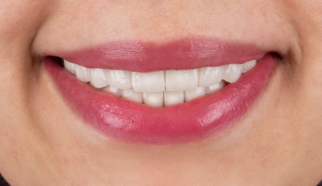 Nachher: Offenes Lächeln mit leuchtend rotem Lippenstift und weißen Zähnen.