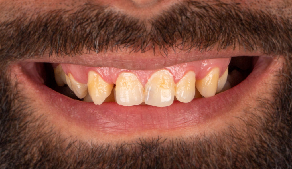 Vorher: Lächeln eines Mannes mit Zahnverfärbungen und unregelmäßigen Zähnen.