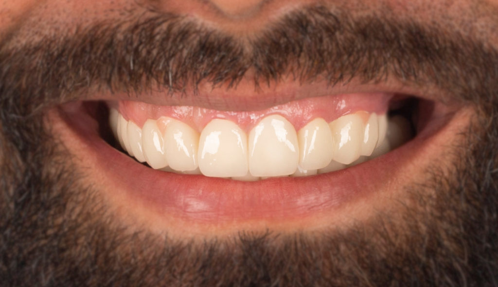Nachher: Mann lächelt mit ebenmäßigen, weißen Zähnen.