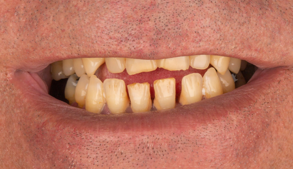 Vorher: Geschlossenes Lächeln mit ungleichmäßigen, gelben Zähnen.