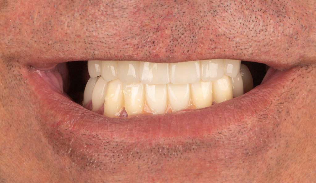 Nachher: Lächeln mit weißen, geraden Zähnen nach kosmetischer Behandlung.