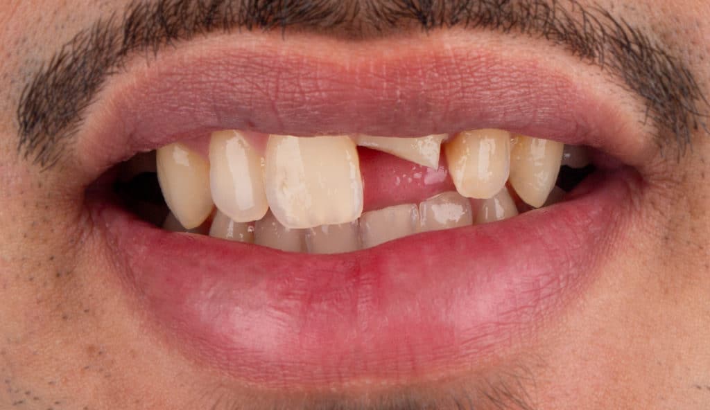 Vorher: Teilweise sichtbare Zähne mit Verfärbungen.