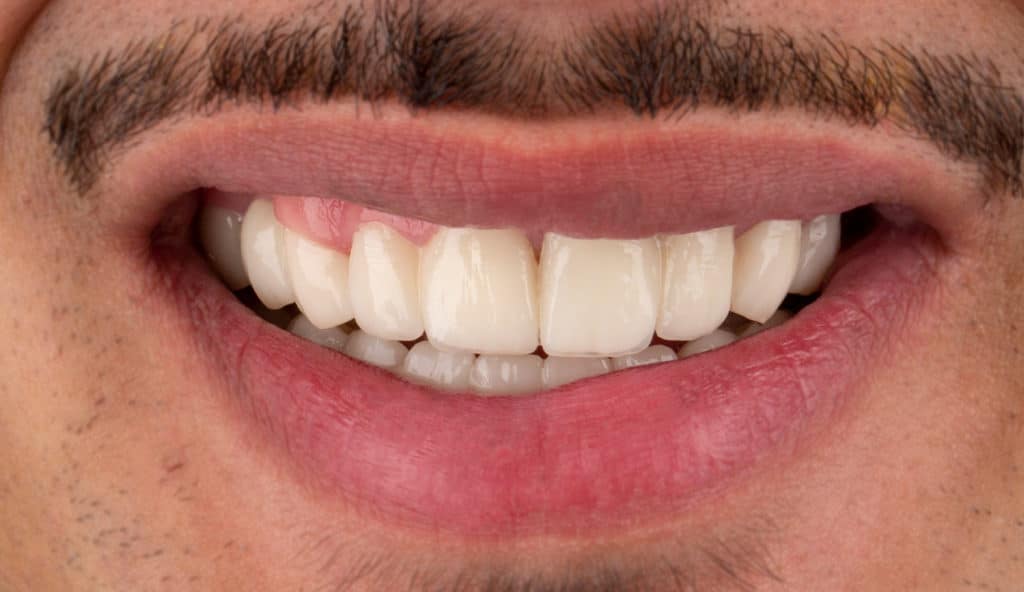 Nachher: Vollständiges Lächeln mit strahlend weißen Zähnen.