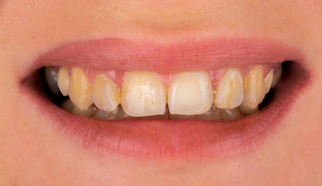 Vorher: Oberkiefer mit mehreren fehlenden Zähnen.