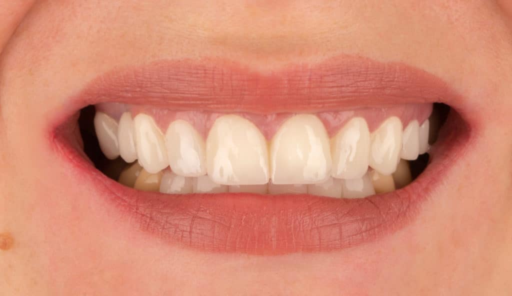 Nachher: Rekonstruiertes Lächeln mit Zahnimplantaten im Oberkiefer.
